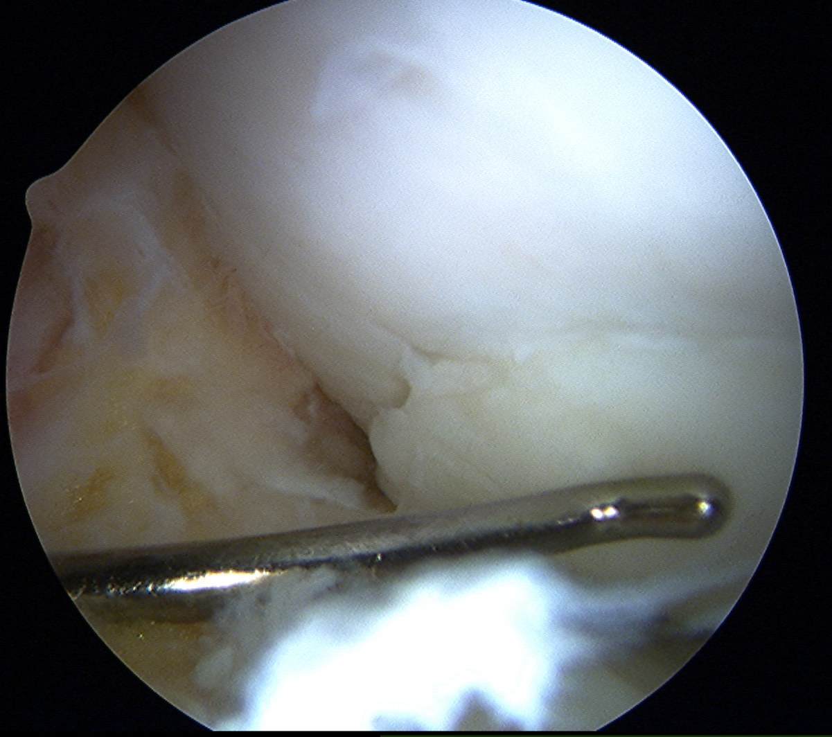 Femoral OCD Reduction 2